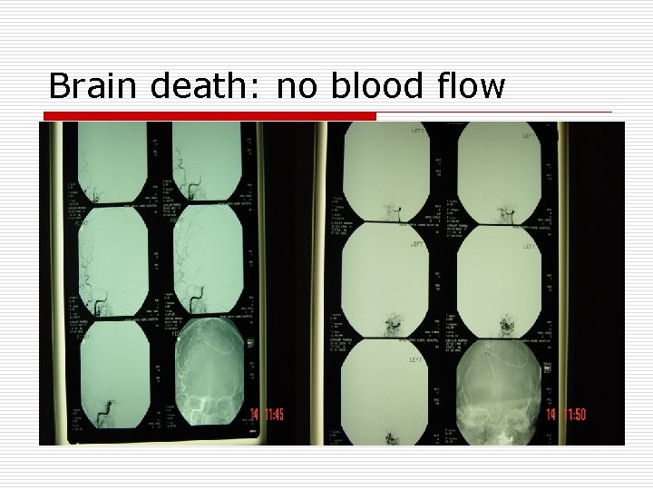 Brain death: no blood flow 