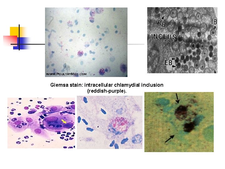 Giemsa stain: intracellular chlamydial inclusion (reddish-purple). 