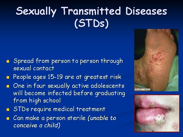 Sexually Transmitted Diseases (STDs) n n n Spread from person to person through sexual