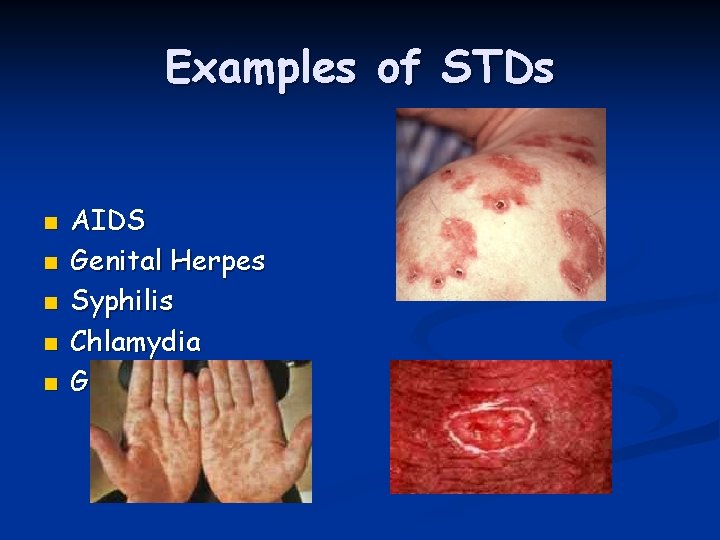 Examples of STDs n n n AIDS Genital Herpes Syphilis Chlamydia Gonorrhea 