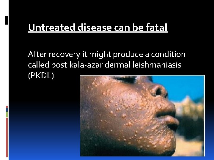 Untreated disease can be fatal After recovery it might produce a condition called post