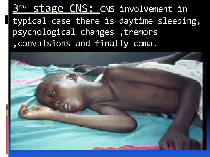 3 rd stage CNS: CNS involvement in typical case there is daytime sleeping, psychological