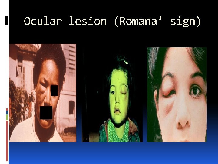 Ocular lesion (Romana’ sign) 