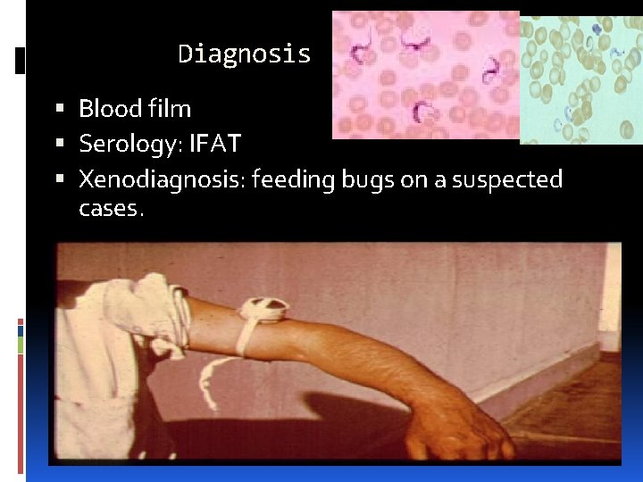 Diagnosis Blood film Serology: IFAT Xenodiagnosis: feeding bugs on a suspected cases. 