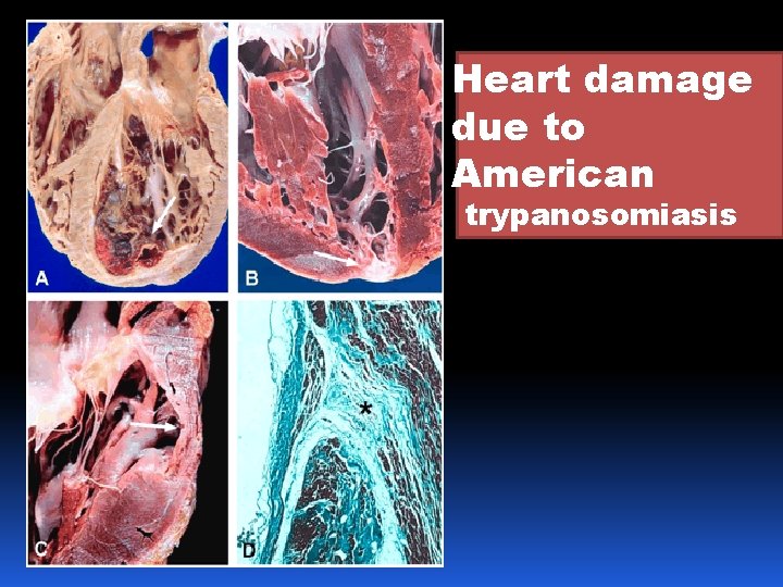 Heart damage due to American trypanosomiasis 
