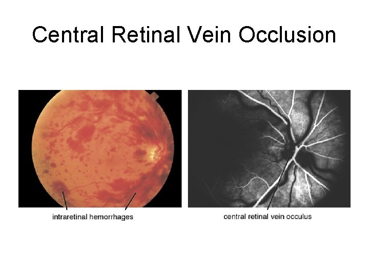 Central Retinal Vein Occlusion 