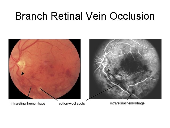 Branch Retinal Vein Occlusion 