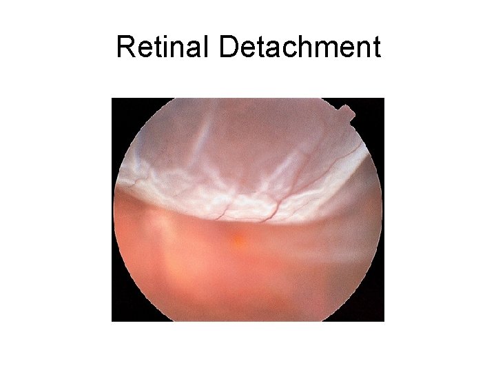 Retinal Detachment 