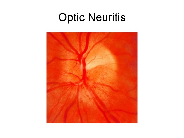 Optic Neuritis 