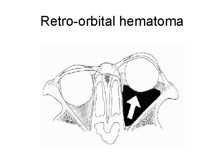 Retro-orbital hematoma 