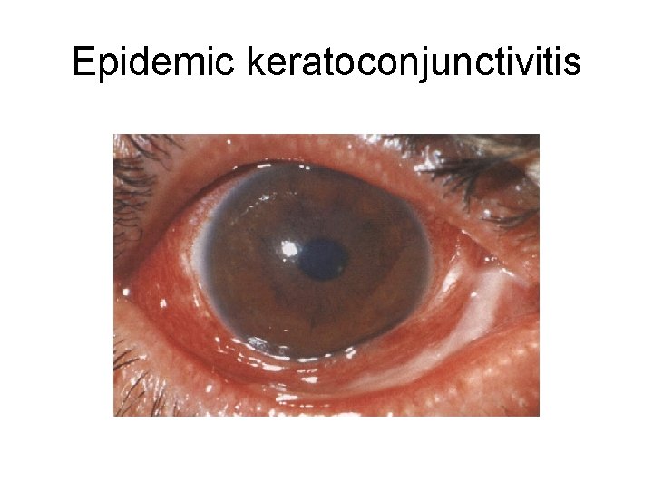 Epidemic keratoconjunctivitis 