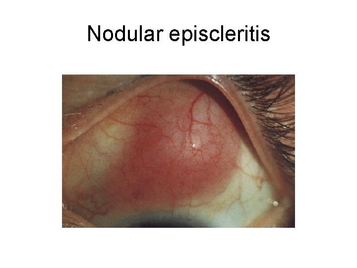 Nodular episcleritis 