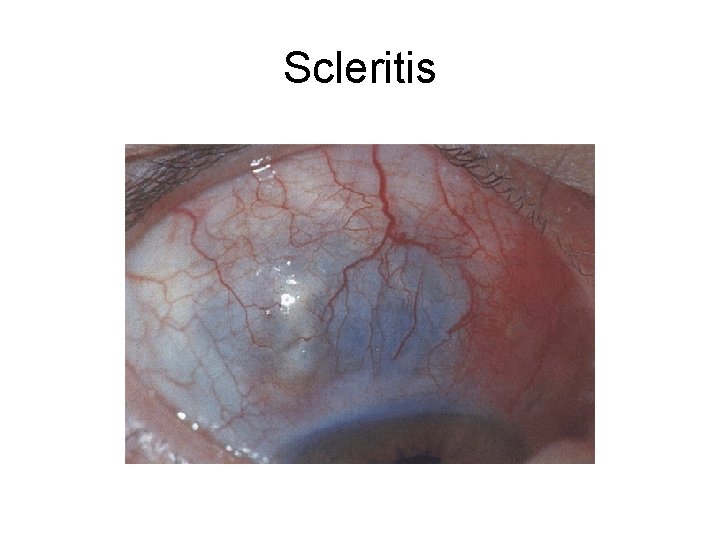 Scleritis 