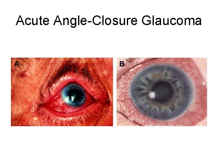 Acute Angle-Closure Glaucoma 