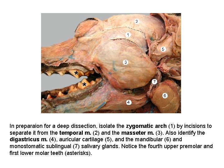 In preparaion for a deep dissection, isolate the zygomatic arch (1) by incisions to