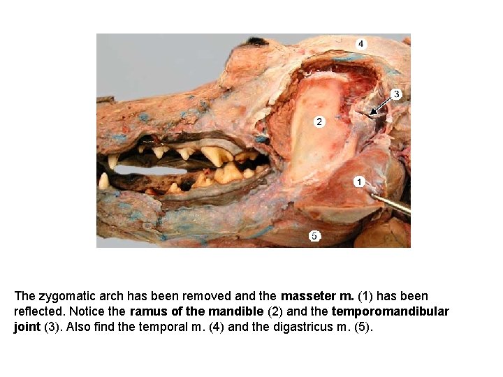 The zygomatic arch has been removed and the masseter m. (1) has been reflected.