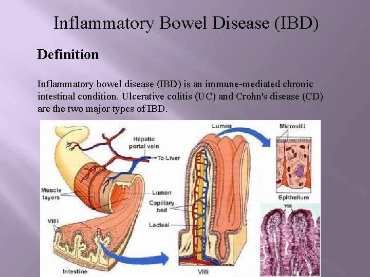 Inflammatory Bowel Disease (IBD) Definition Inflammatory bowel disease (IBD) is an immune-mediated chronic intestinal