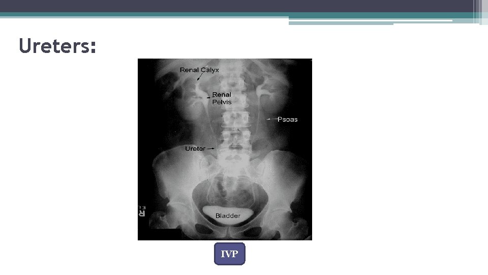 Ureters: IVP 