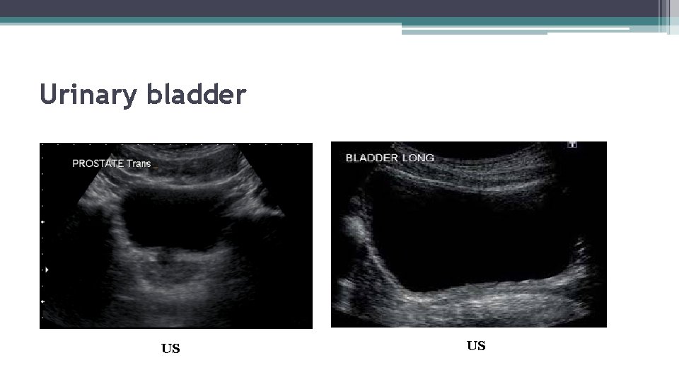 Urinary bladder US US 