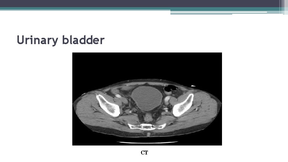 Urinary bladder CT 