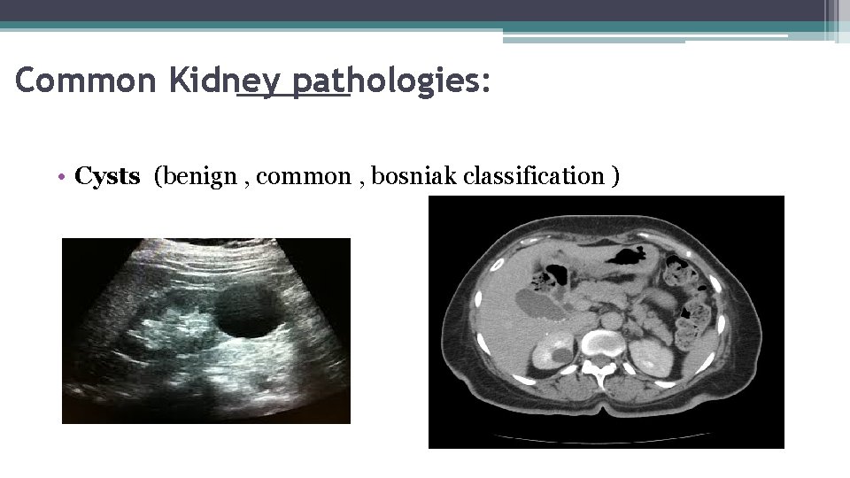 Common Kidney pathologies: • Cysts (benign , common , bosniak classification ) 
