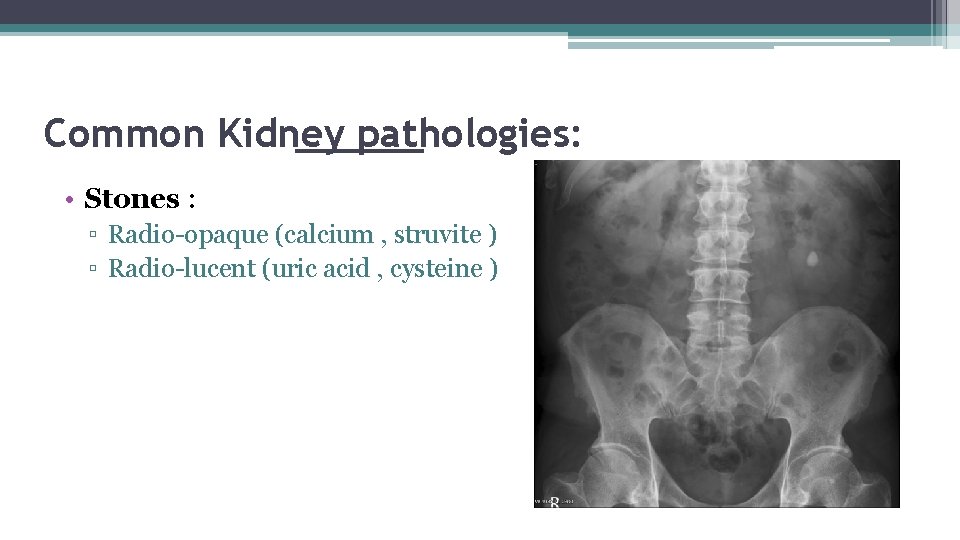 Common Kidney pathologies: • Stones : ▫ Radio-opaque (calcium , struvite ) ▫ Radio-lucent