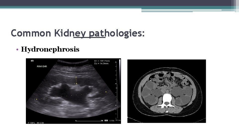 Common Kidney pathologies: • Hydronephrosis 