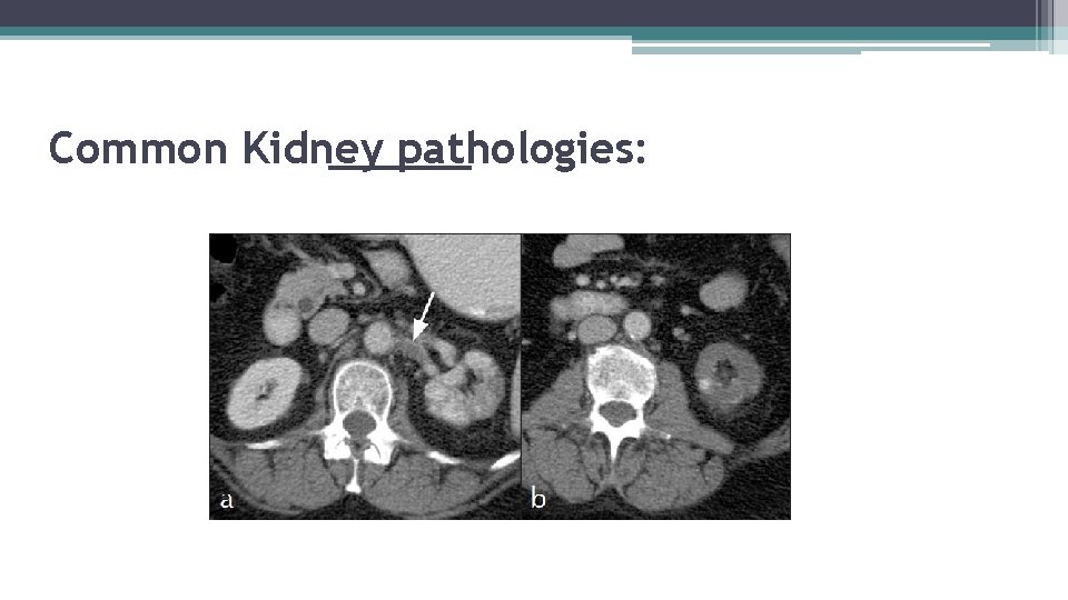 Common Kidney pathologies: 