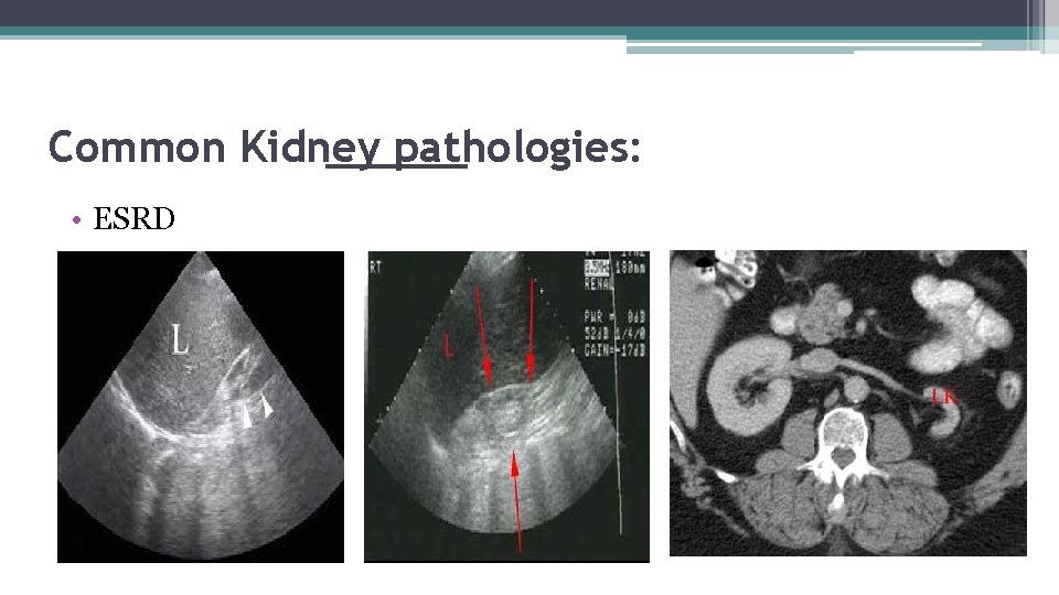 Common Kidney pathologies: • ESRD 