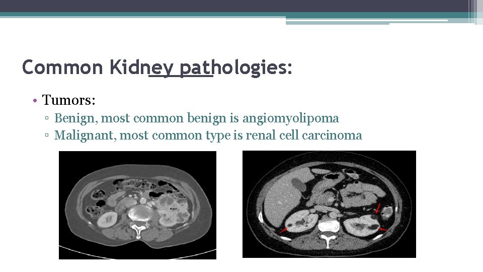 Common Kidney pathologies: • Tumors: ▫ Benign, most common benign is angiomyolipoma ▫ Malignant,