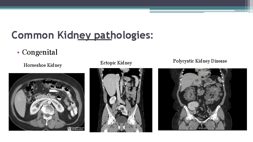 Common Kidney pathologies: • Congenital Horseshoe Kidney Ectopic Kidney Polycystic Kidney Disease 