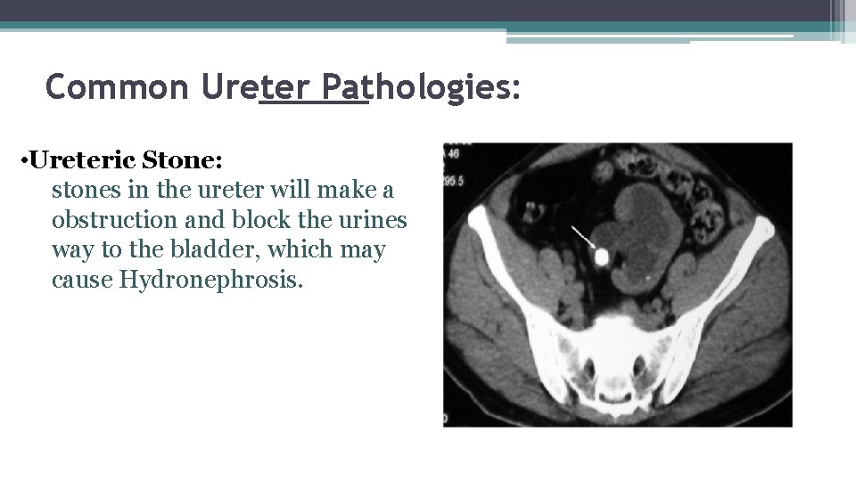 Common Ureter Pathologies: • Ureteric Stone: stones in the ureter will make a obstruction