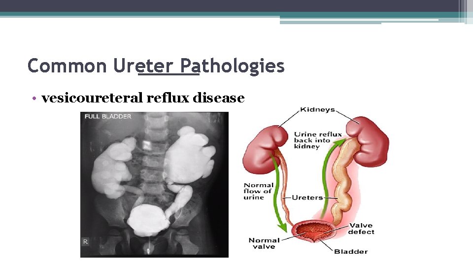 Common Ureter Pathologies • vesicoureteral reflux disease 