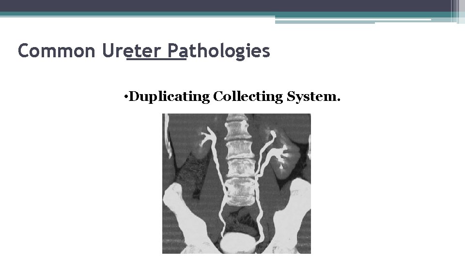 Common Ureter Pathologies • Duplicating Collecting System. 