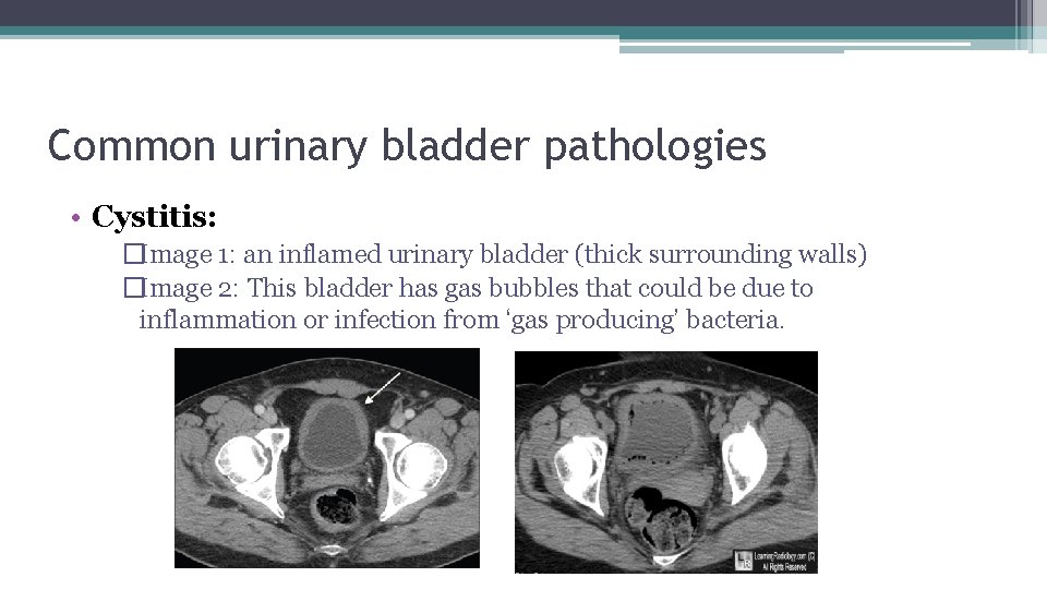 Common urinary bladder pathologies • Cystitis: �Image 1: an inflamed urinary bladder (thick surrounding