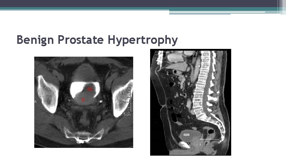 Benign Prostate Hypertrophy 