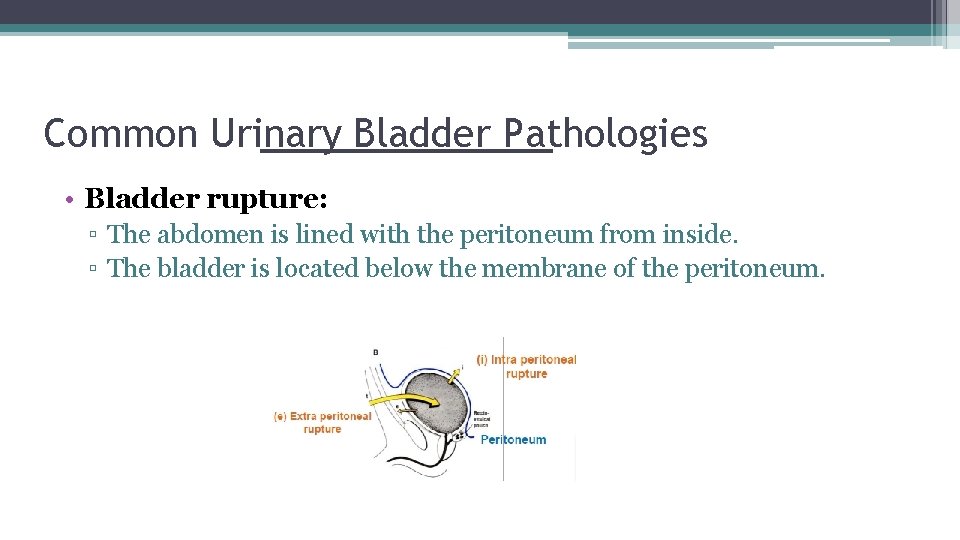 Common Urinary Bladder Pathologies • Bladder rupture: ▫ The abdomen is lined with the