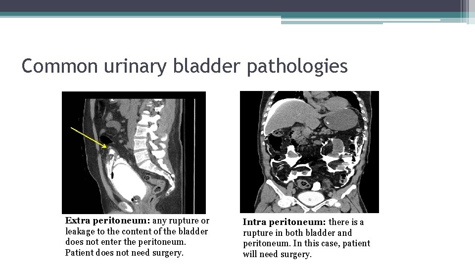 Common urinary bladder pathologies Extra peritoneum: any rupture or leakage to the content of