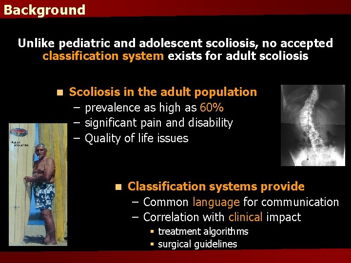 Background Unlike pediatric and adolescent scoliosis, no accepted classification system exists for adult scoliosis