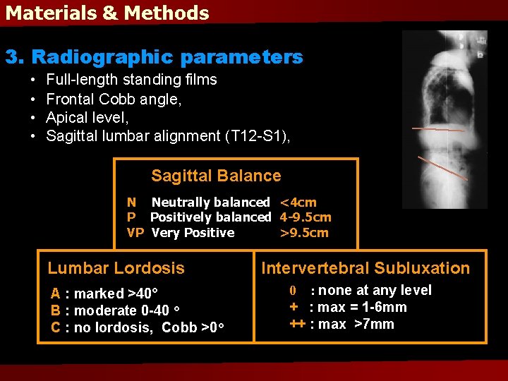 Materials & Methods 3. Radiographic parameters • • Full-length standing films Frontal Cobb angle,