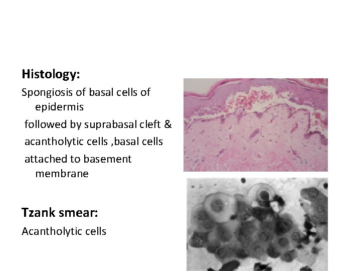 Histology: Spongiosis of basal cells of epidermis followed by suprabasal cleft & acantholytic cells