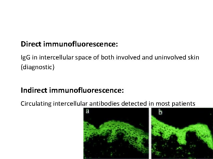 Direct immunofluorescence: Ig. G in intercellular space of both involved and uninvolved skin (diagnostic)