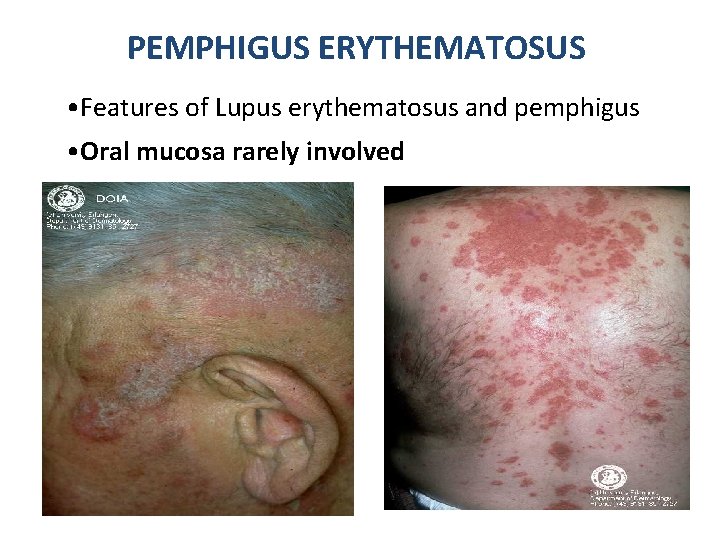 PEMPHIGUS ERYTHEMATOSUS • Features of Lupus erythematosus and pemphigus • Oral mucosa rarely involved