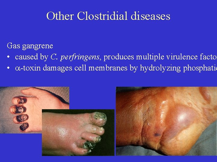 Other Clostridial diseases Gas gangrene • caused by C. perfringens, produces multiple virulence factor