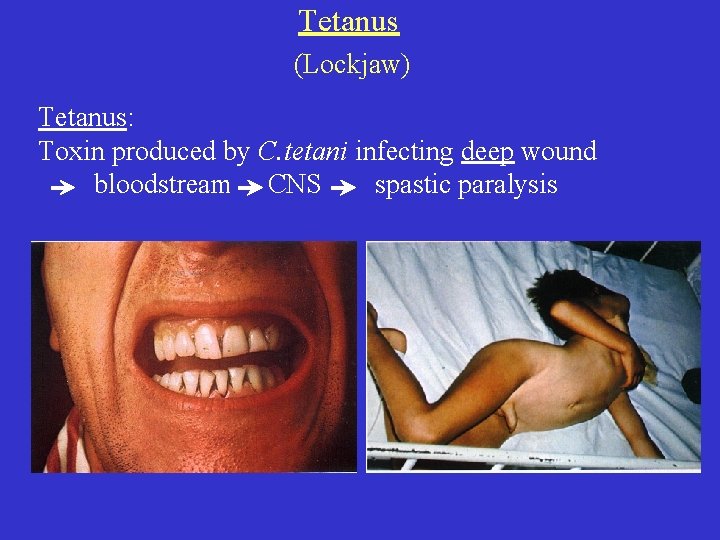 Tetanus (Lockjaw) Tetanus: Toxin produced by C. tetani infecting deep wound bloodstream CNS spastic