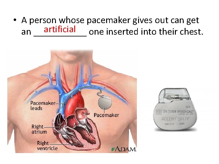  • A person whose pacemaker gives out can get artificial an ______ one