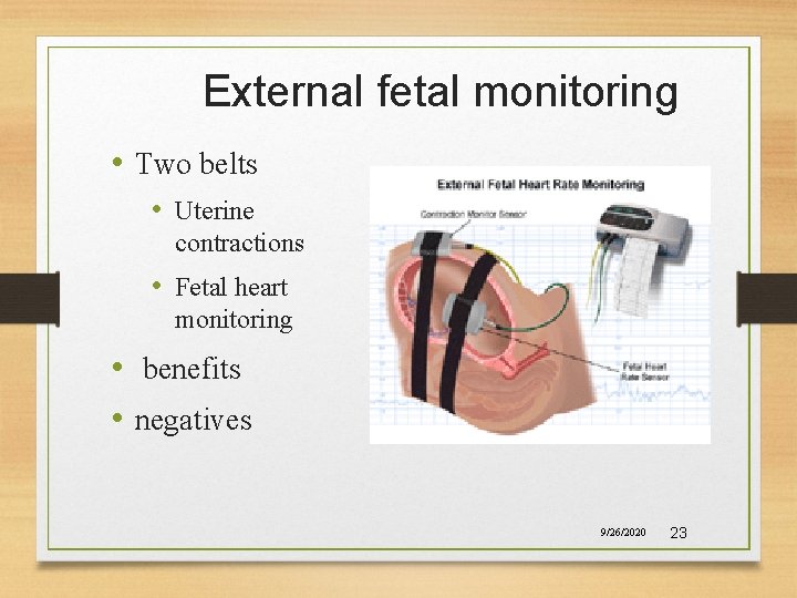 External fetal monitoring • Two belts • Uterine contractions • Fetal heart monitoring •