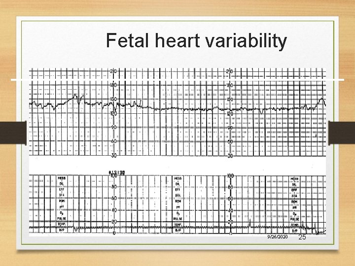 Fetal heart variability 9/26/2020 25 