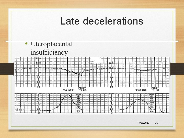 Late decelerations • Uteroplacental insufficiency 9/26/2020 27 