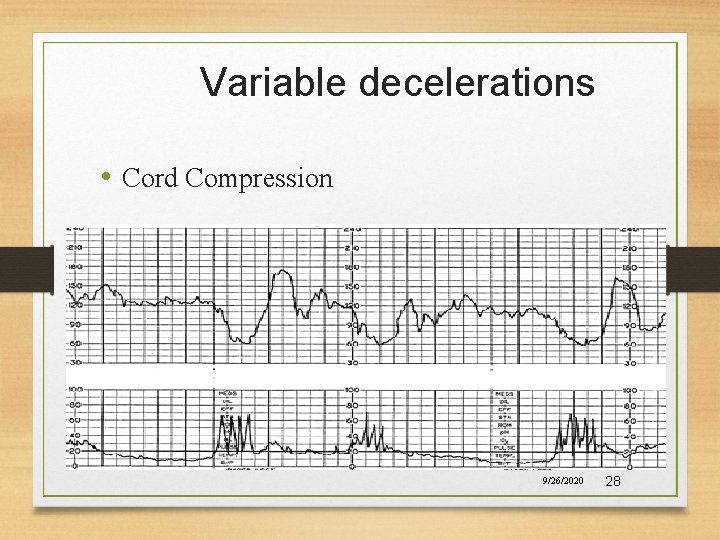 Variable decelerations • Cord Compression 9/26/2020 28 